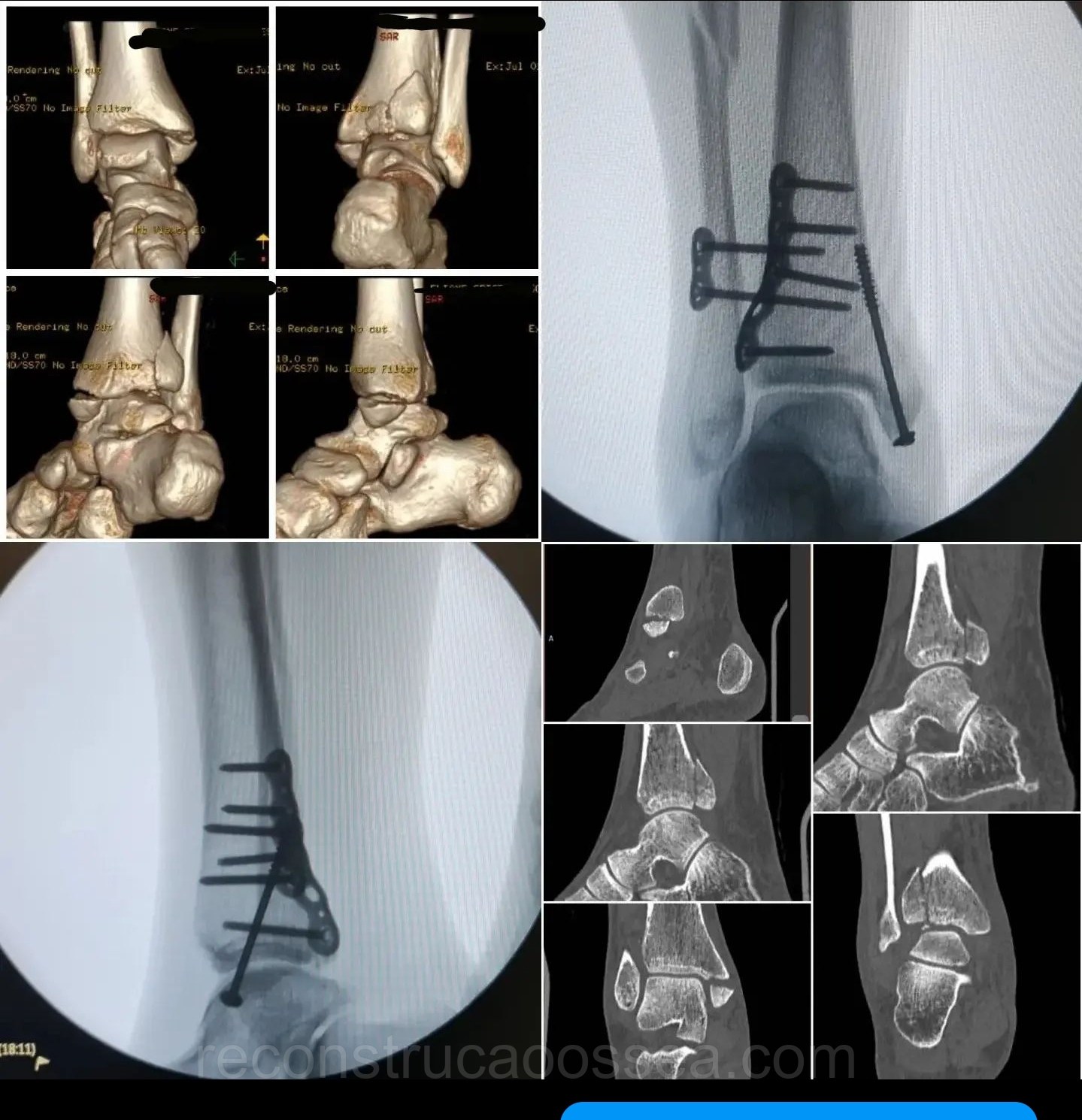 fratura-do-tornozelo-tratamento-cirurgico-19