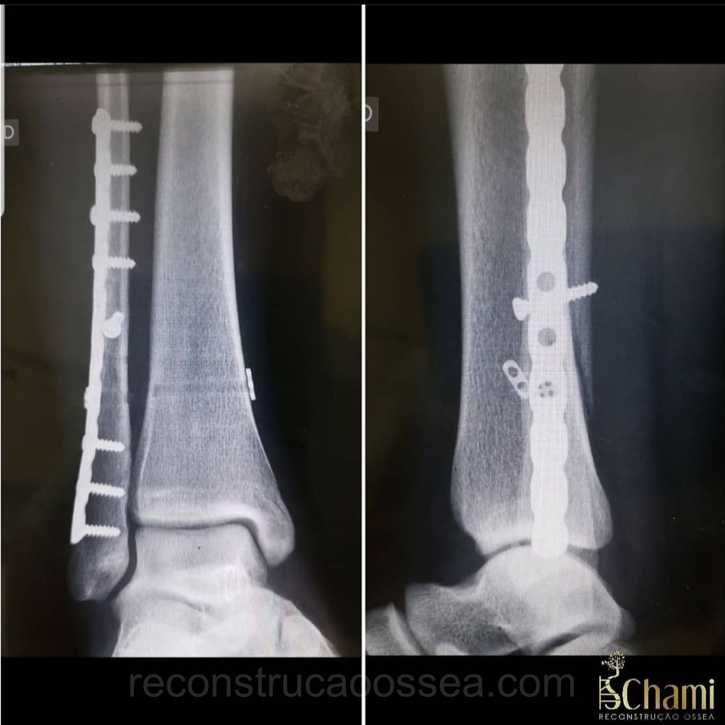 fratura-do-tornozelo-tratamento-cirurgico-2