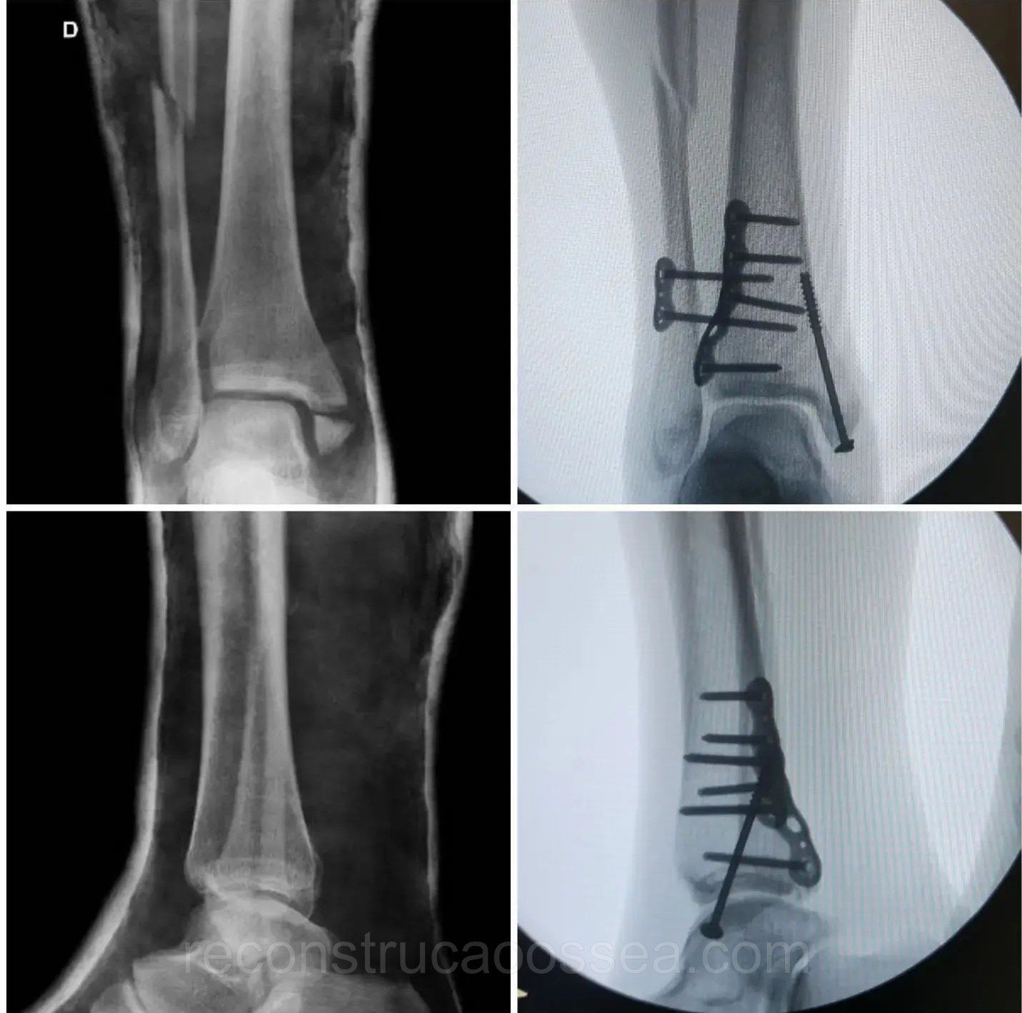 fratura-do-tornozelo-tratamento-cirurgico-20