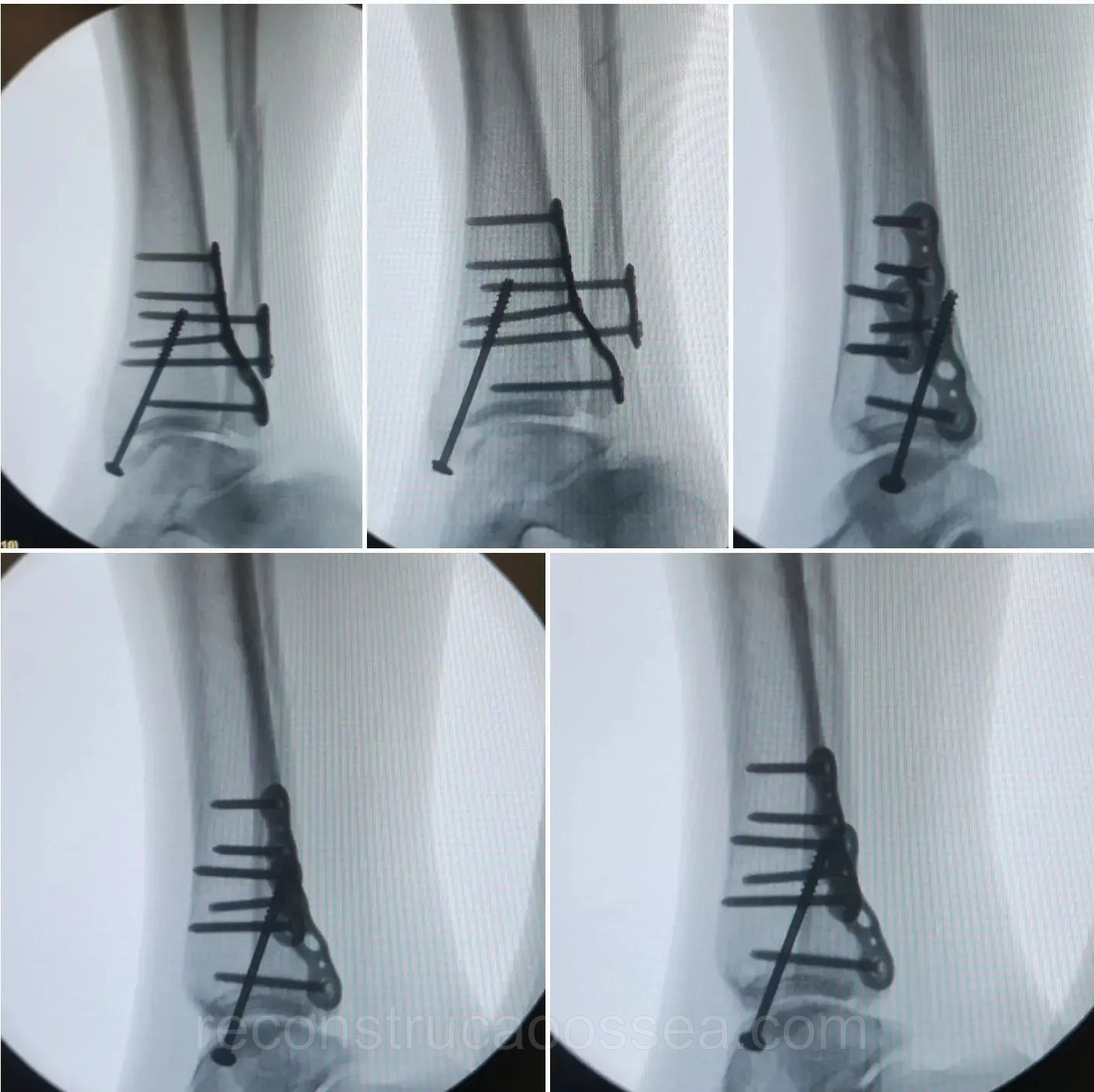 fratura-do-tornozelo-tratamento-cirurgico-21