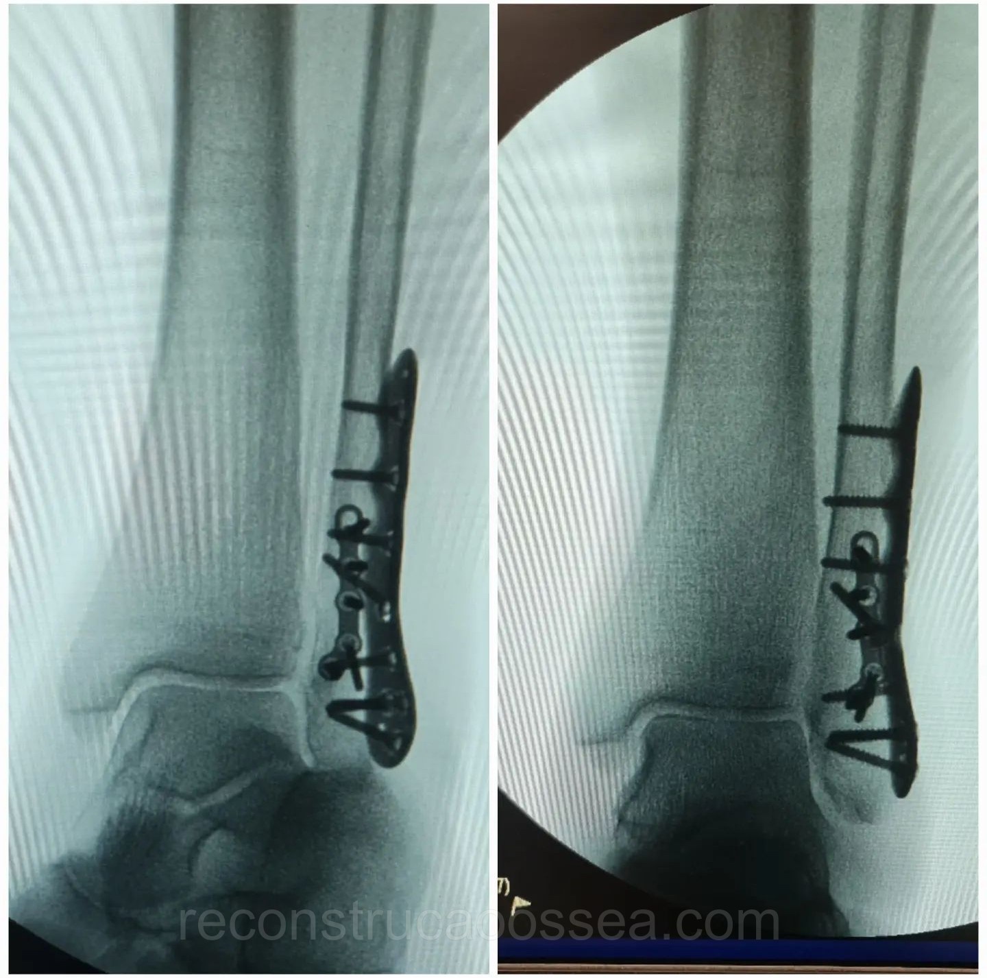 fratura-do-tornozelo-tratamento-cirurgico-22