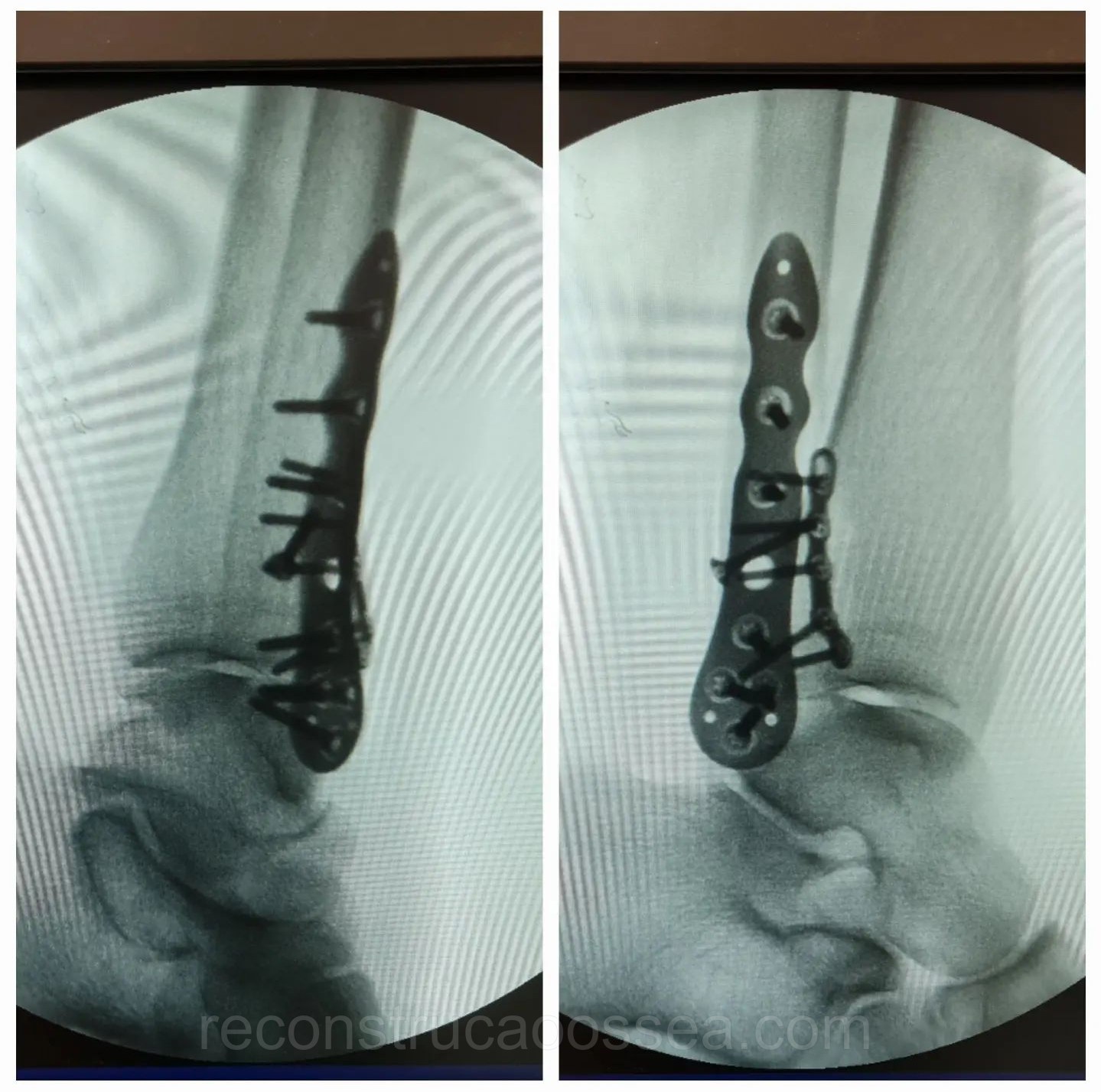 fratura-do-tornozelo-tratamento-cirurgico-23