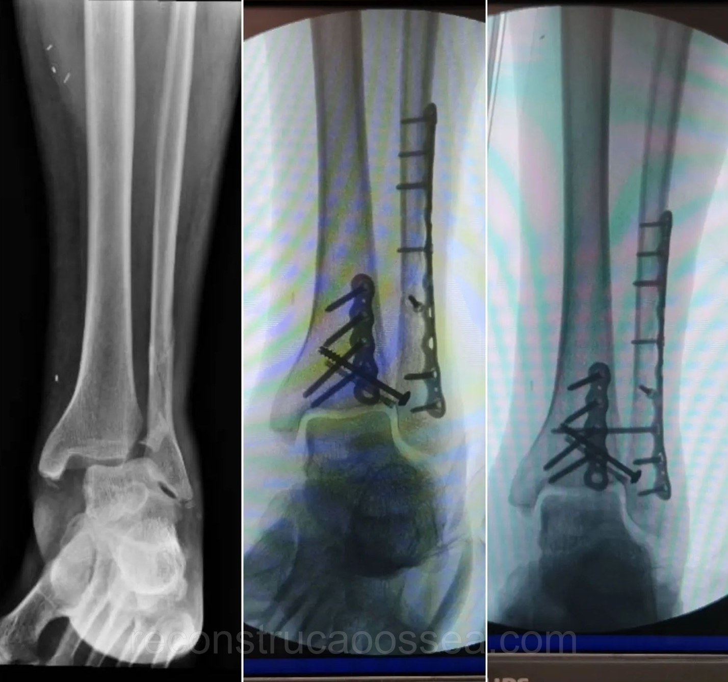 fratura-do-tornozelo-tratamento-cirurgico-24