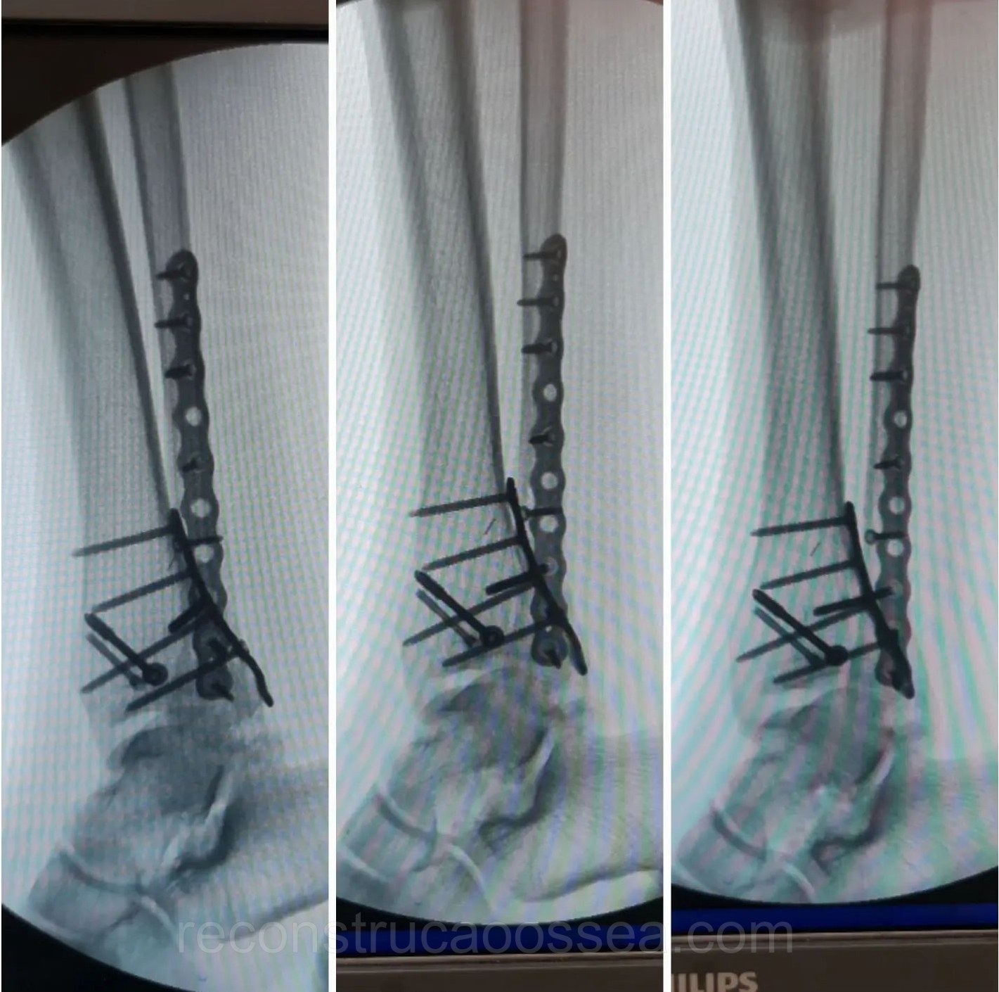 fratura-do-tornozelo-tratamento-cirurgico-25