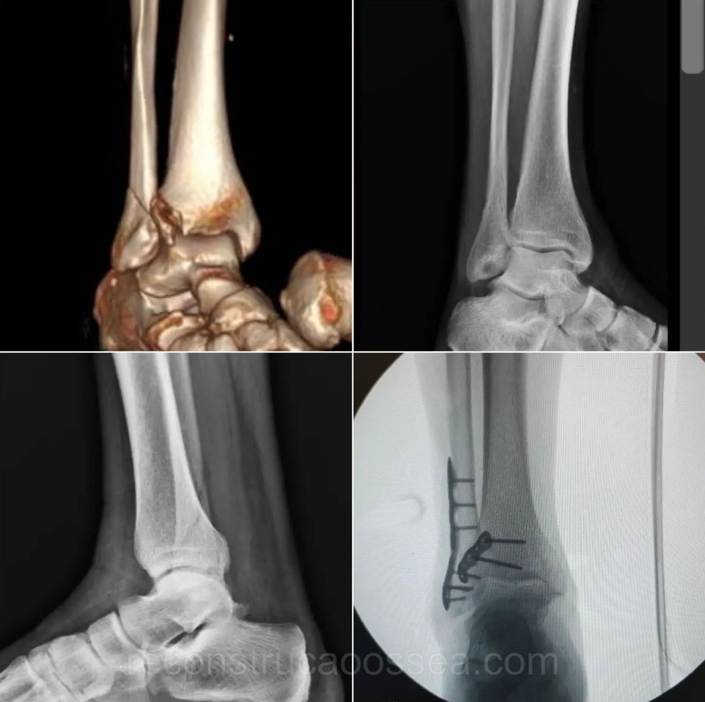 fratura-do-tornozelo-tratamento-cirurgico-26
