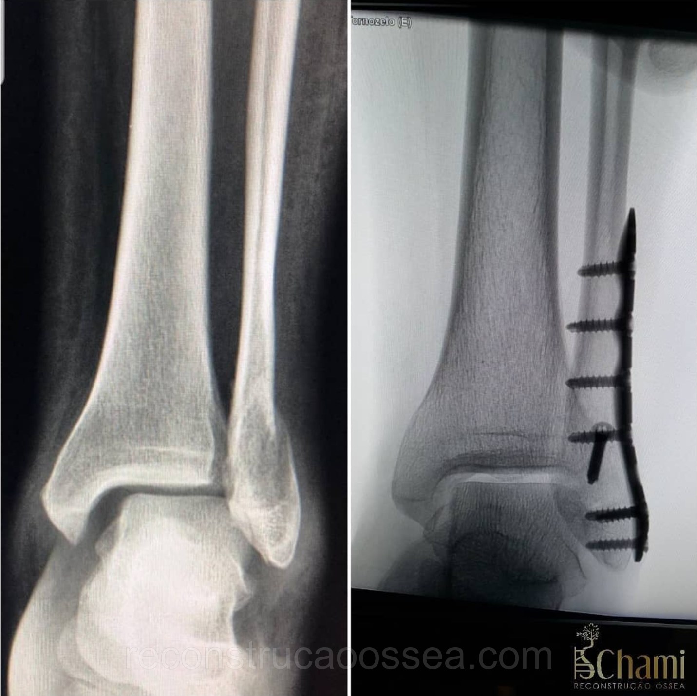 fratura-do-tornozelo-tratamento-cirurgico-3