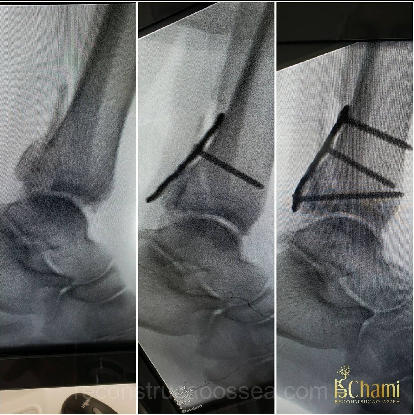 fratura-do-tornozelo-tratamento-cirurgico-4