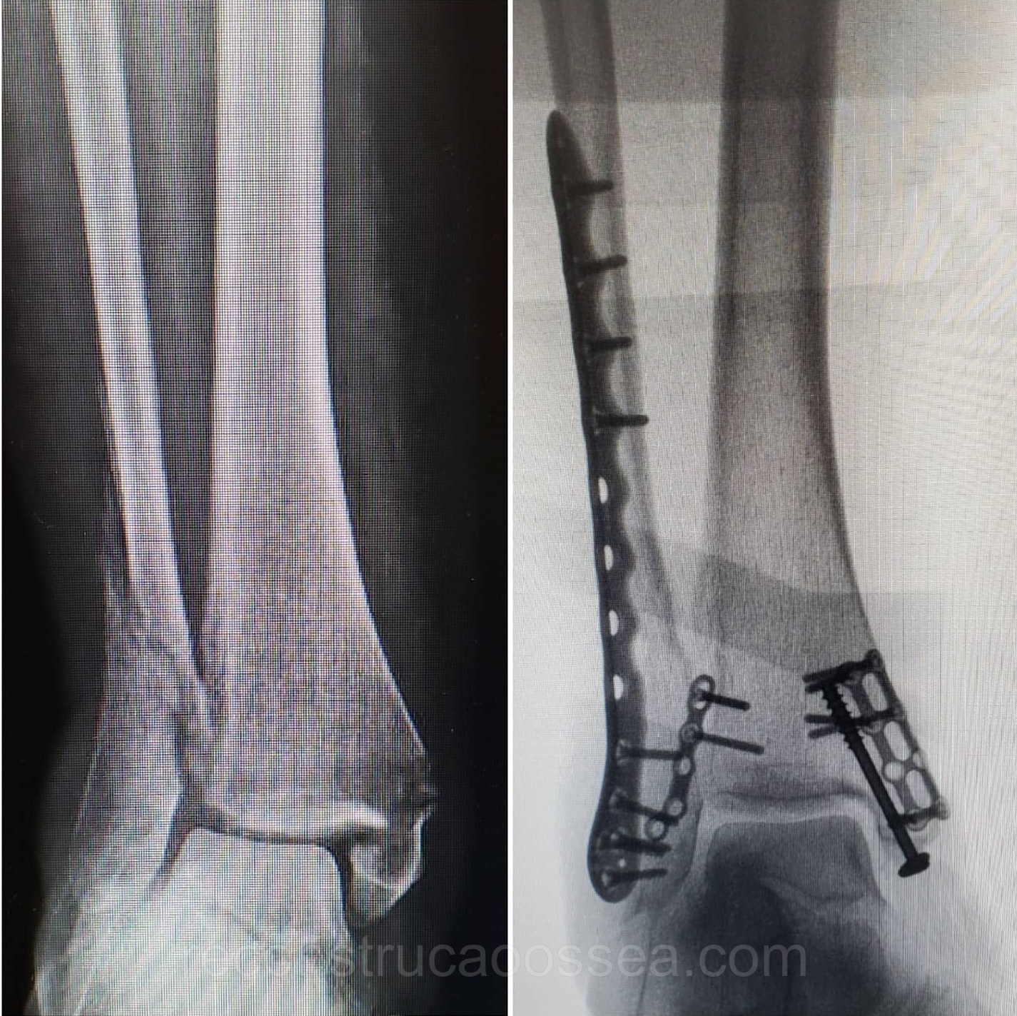 fratura-do-tornozelo-tratamento-cirurgico-5