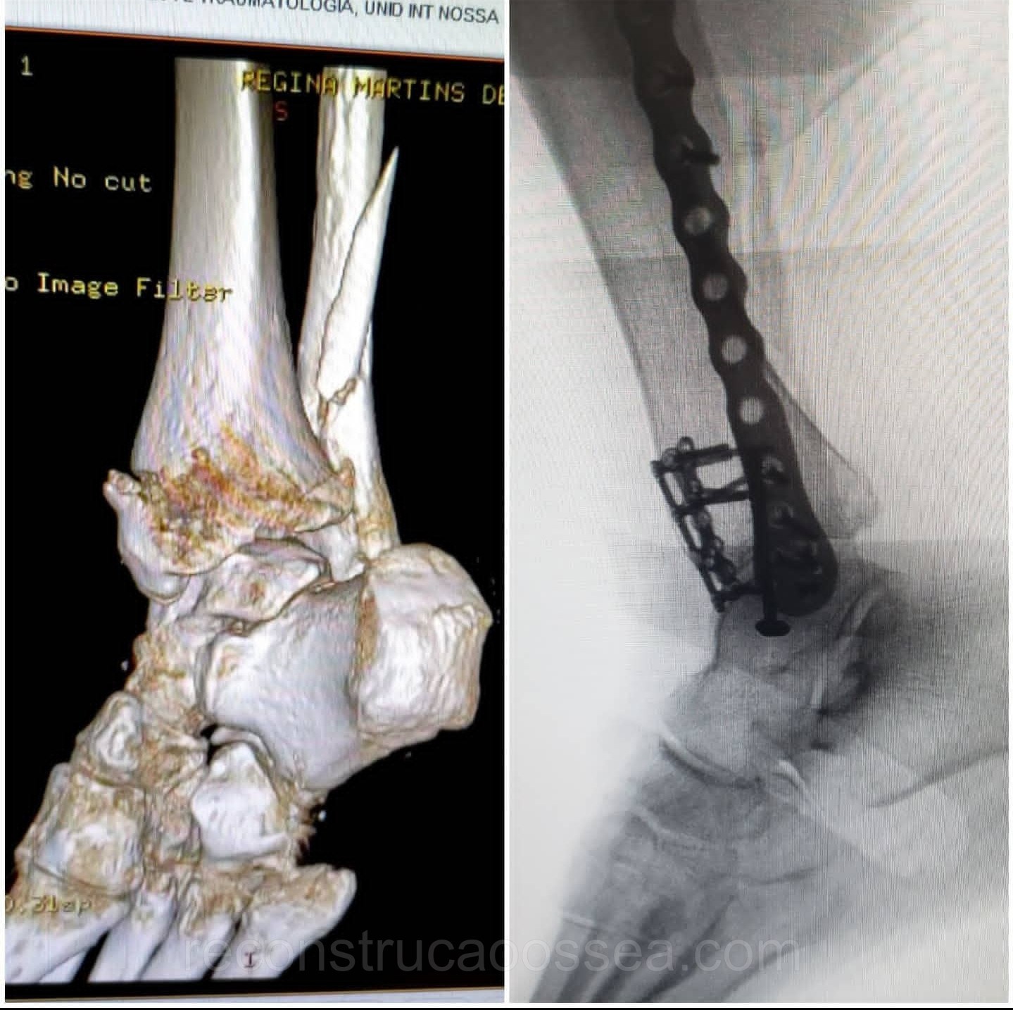 fratura-do-tornozelo-tratamento-cirurgico-6