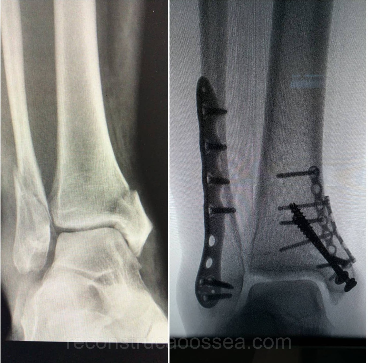 fratura-do-tornozelo-tratamento-cirurgico-8