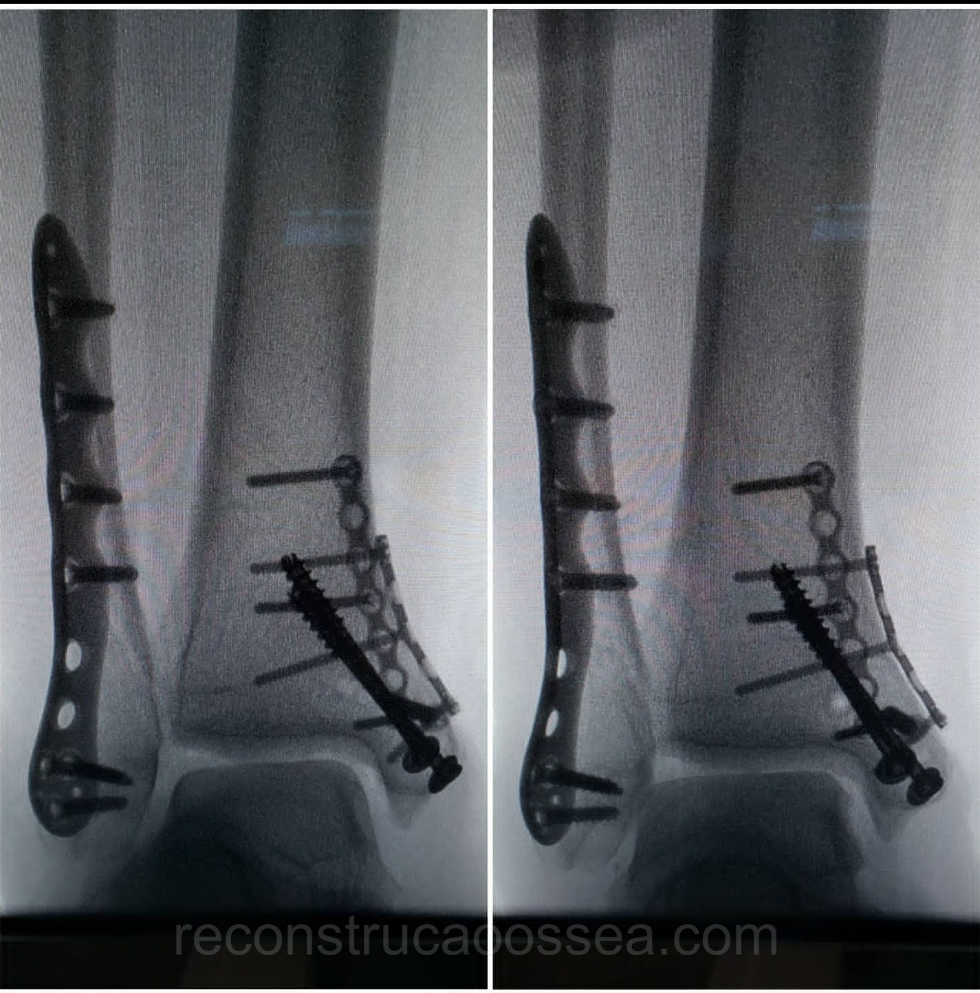 fratura-do-tornozelo-tratamento-cirurgico-9