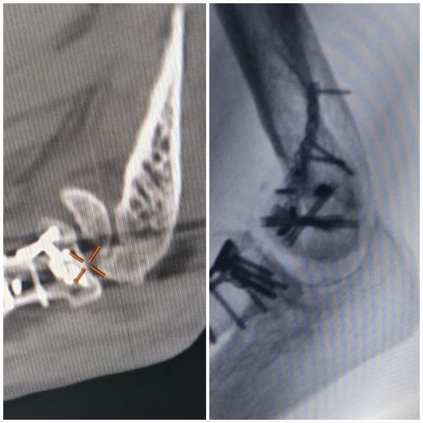 fratura-do-umero-distal-2