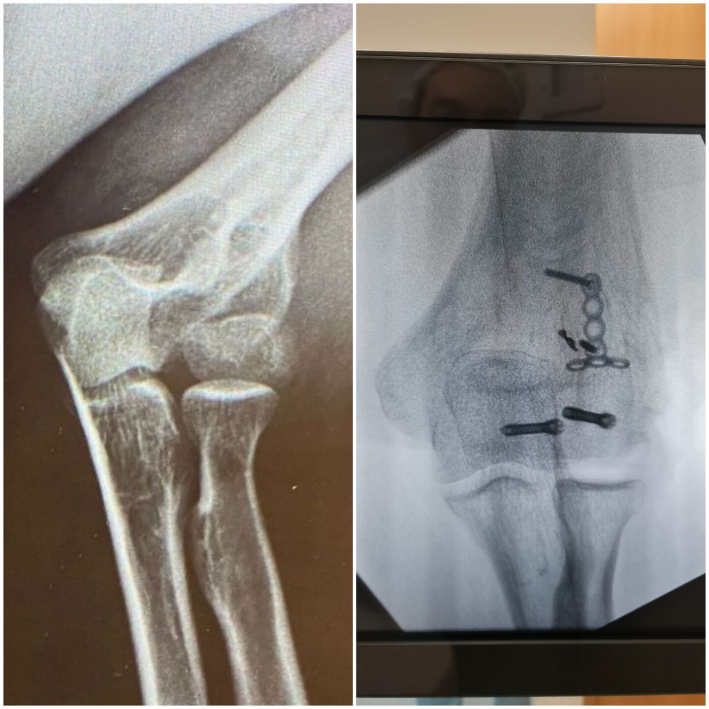 fratura-do-umero-distal-3