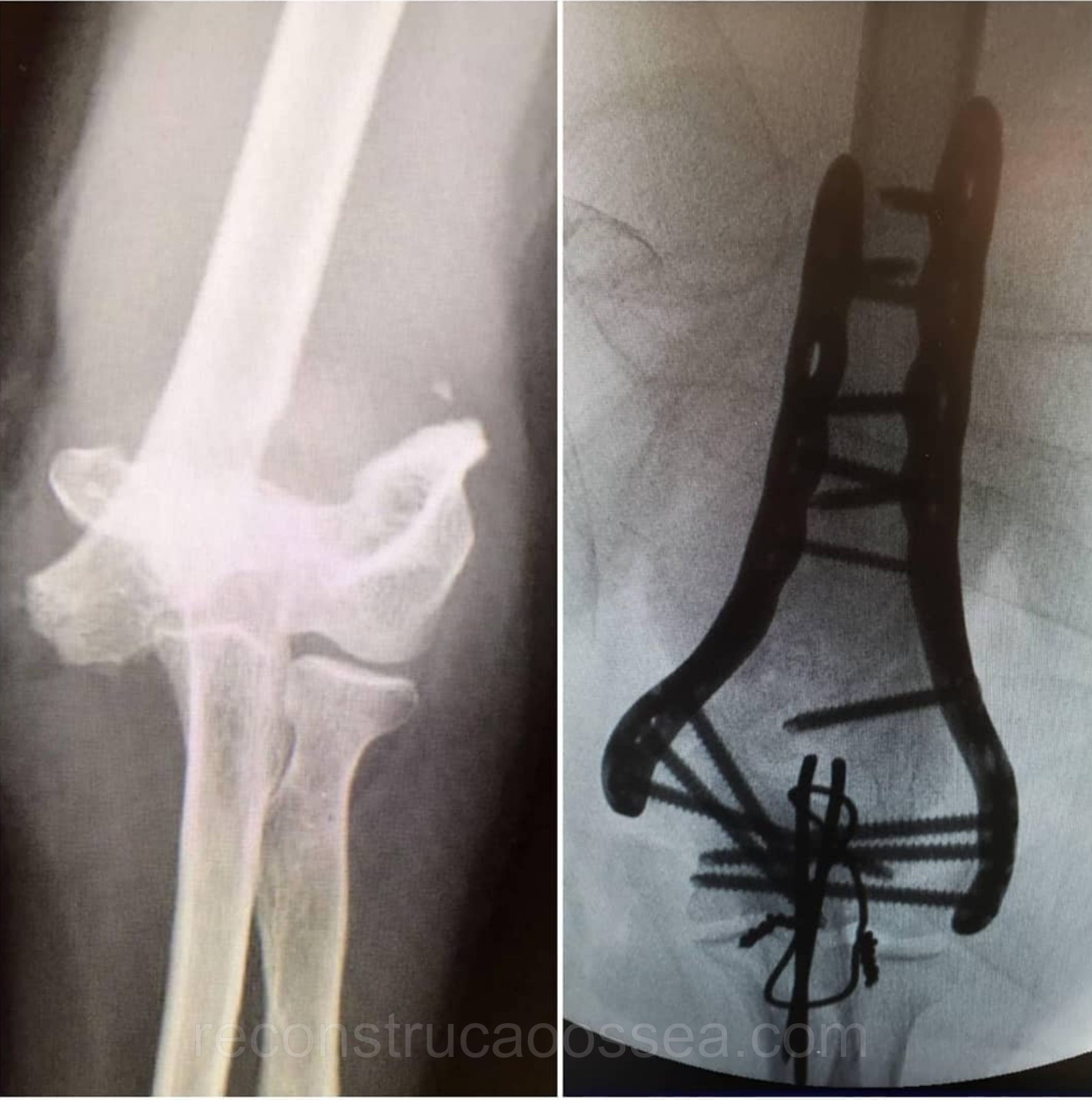 fratura-do-umero-distal-tratamento-cirurgico-1