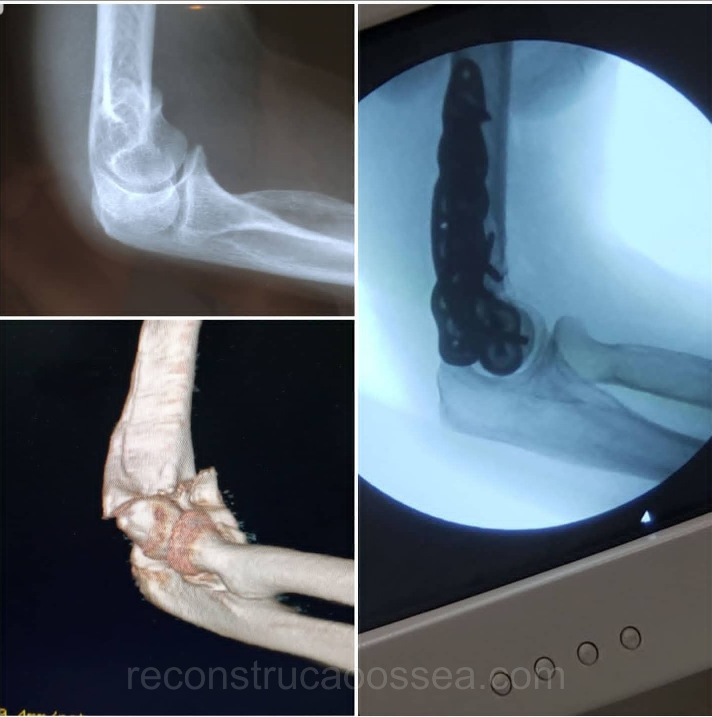 fratura-do-umero-distal-tratamento-cirurgico-10