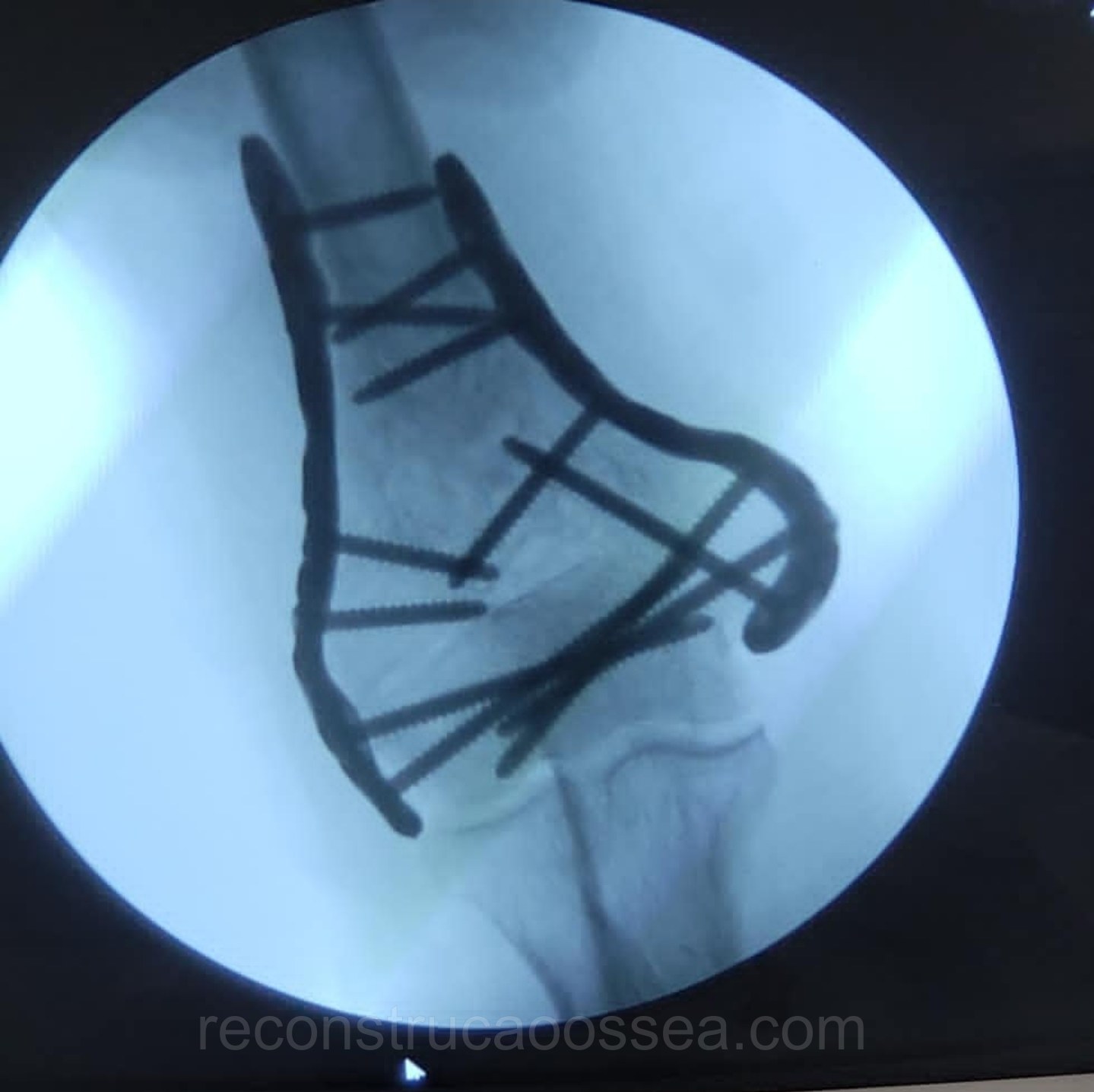 fratura-do-umero-distal-tratamento-cirurgico-11