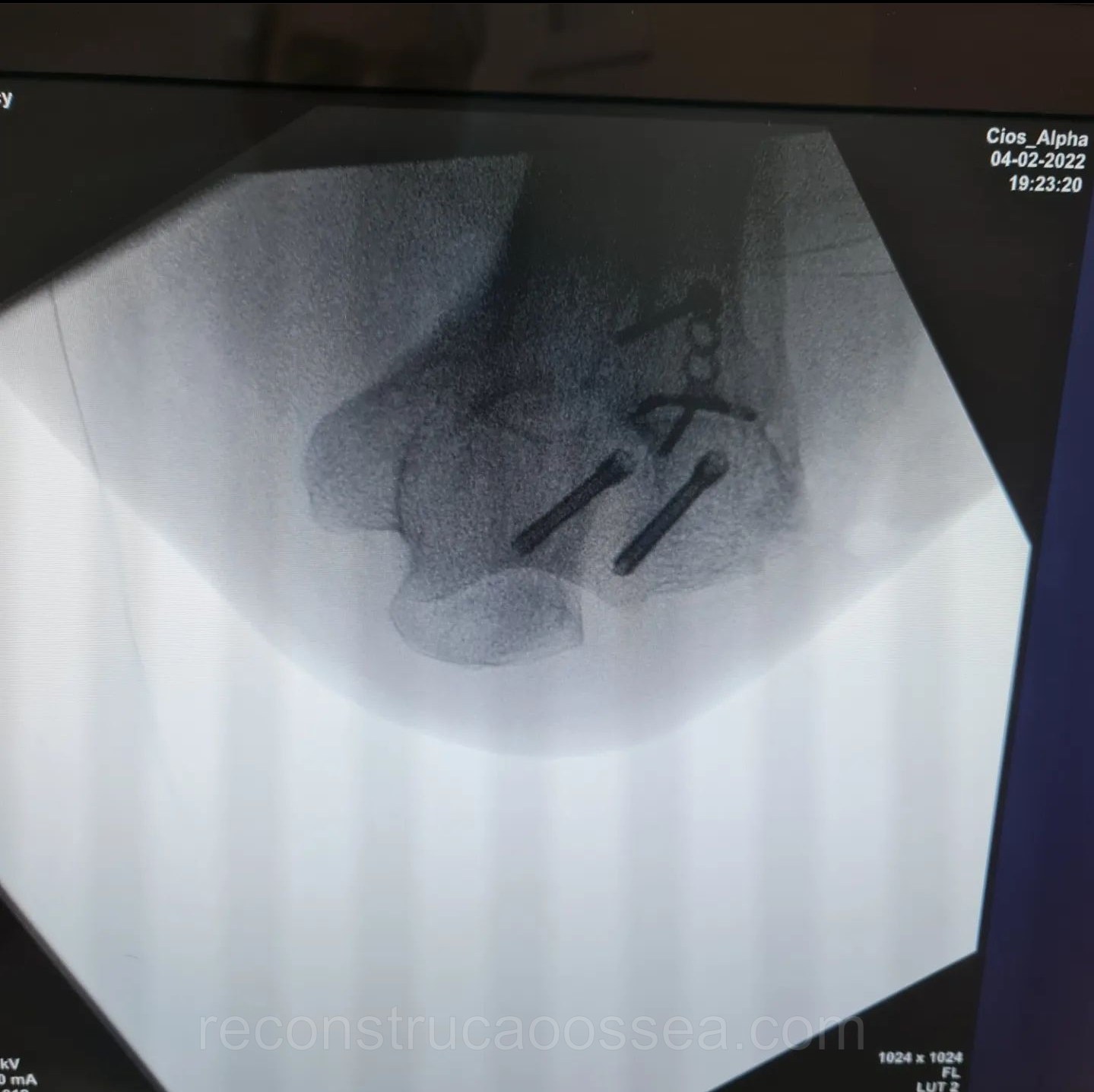 fratura-do-umero-distal-tratamento-cirurgico-14