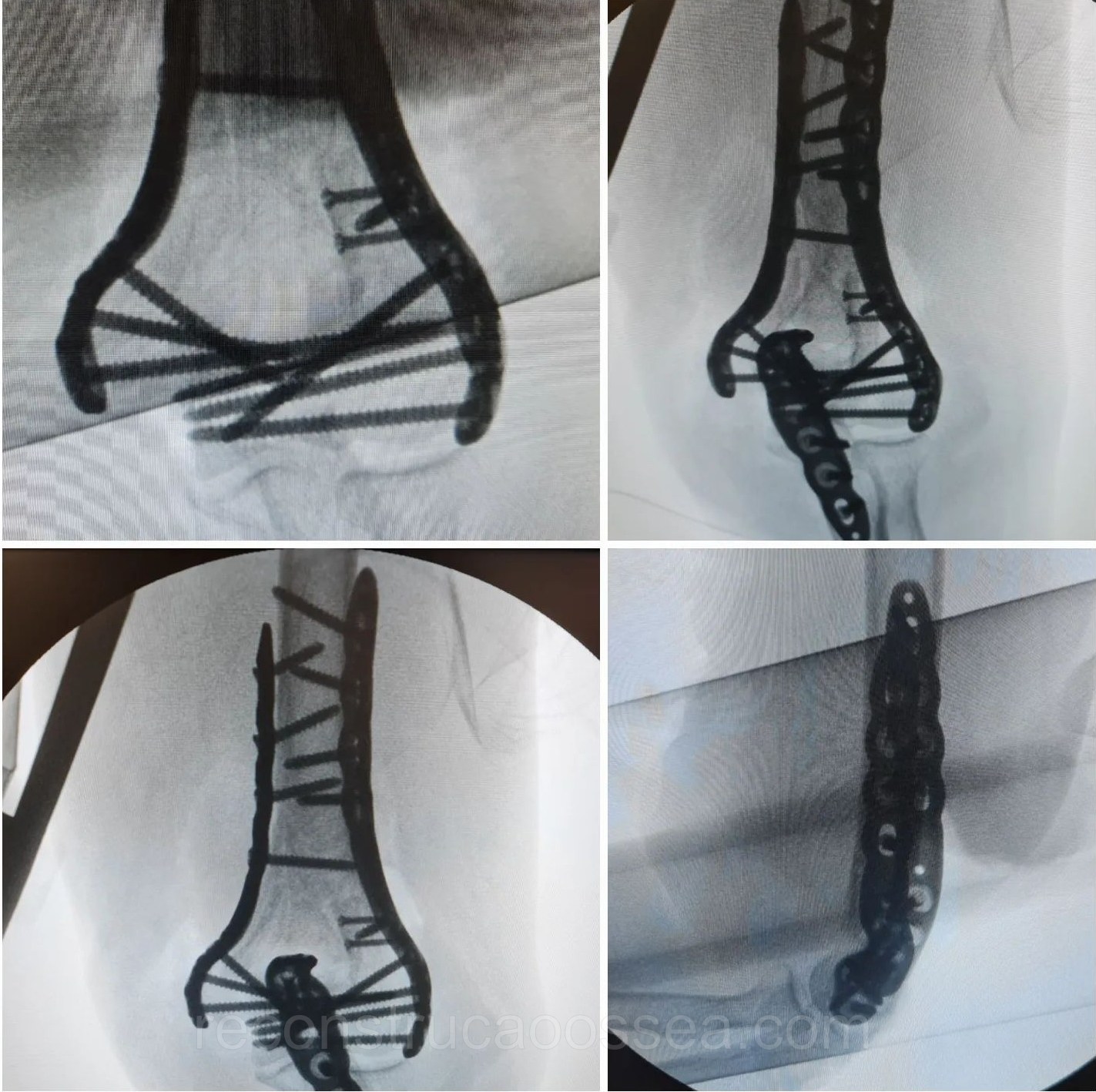 fratura-do-umero-distal-tratamento-cirurgico-16