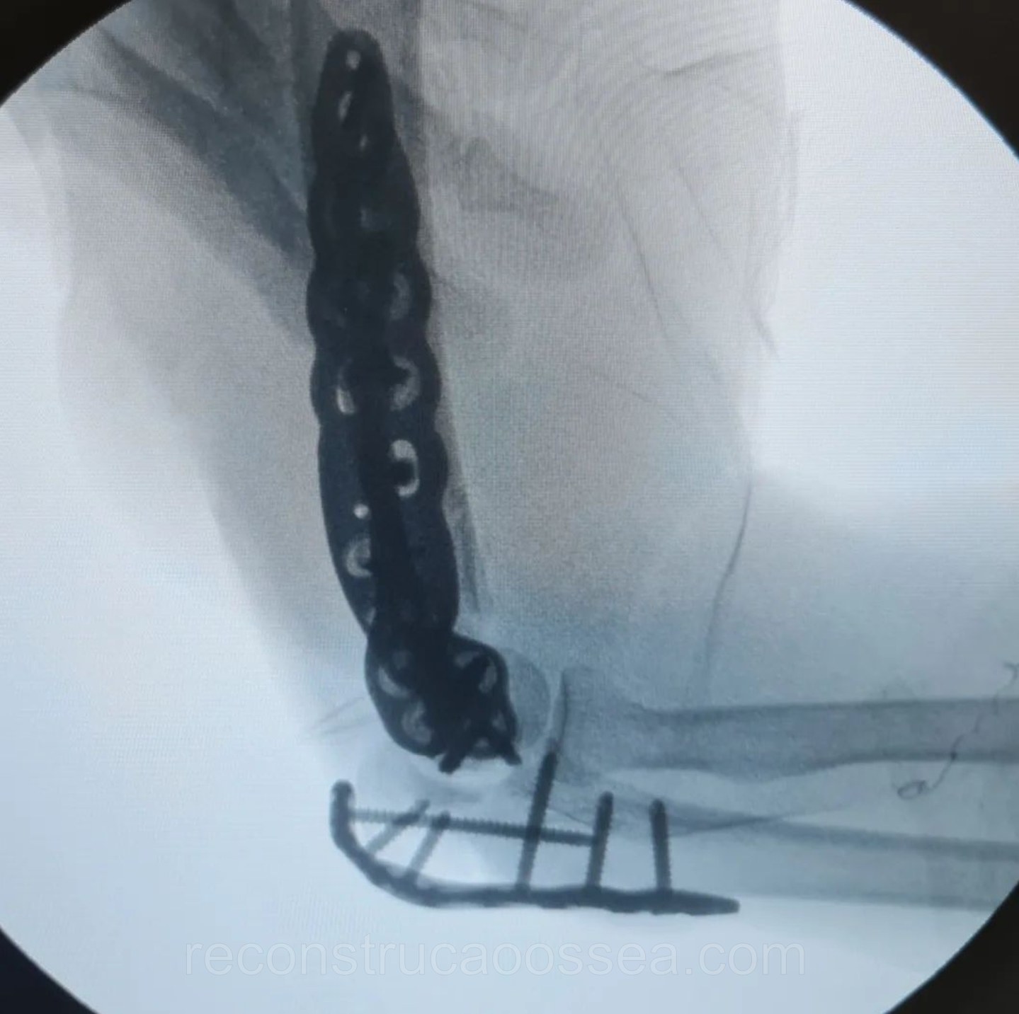 fratura-do-umero-distal-tratamento-cirurgico-19