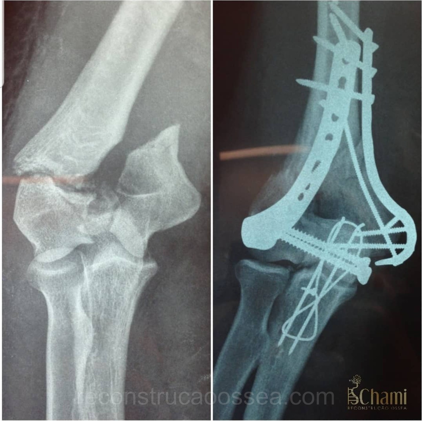 fratura-do-umero-distal-tratamento-cirurgico-2