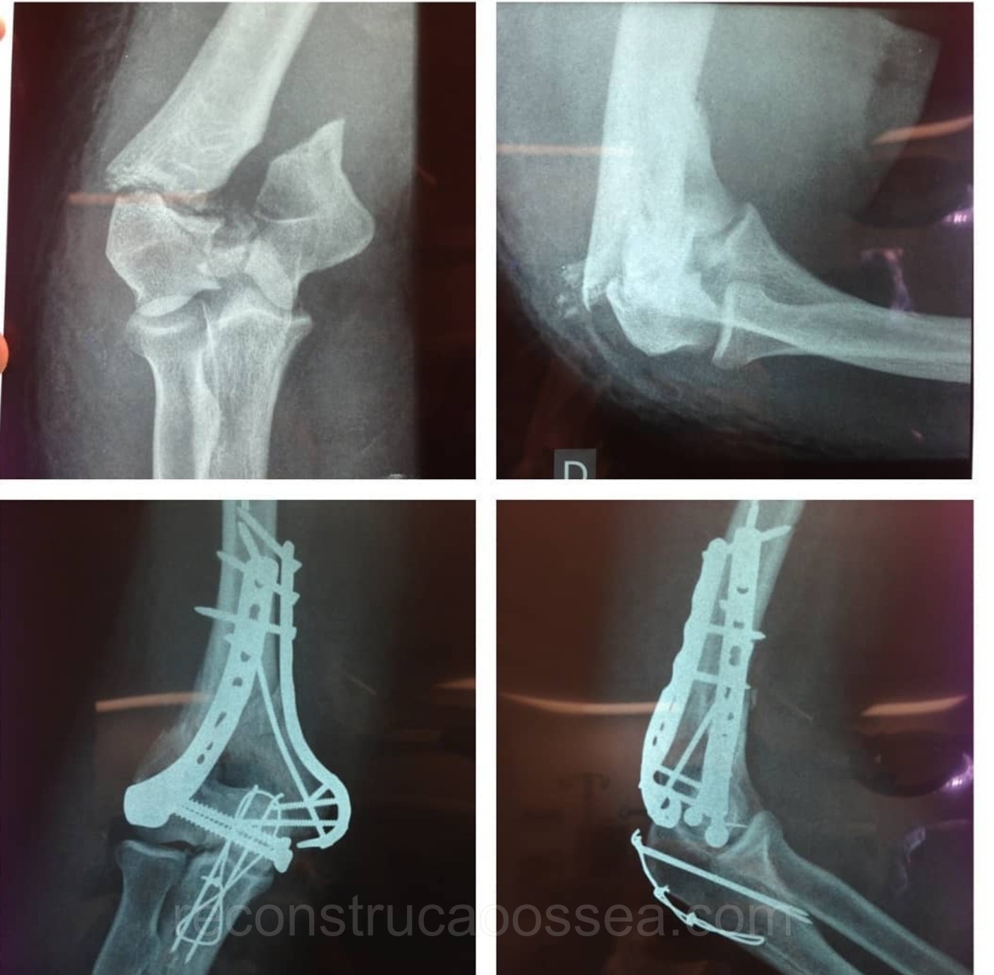 fratura-do-umero-distal-tratamento-cirurgico-3