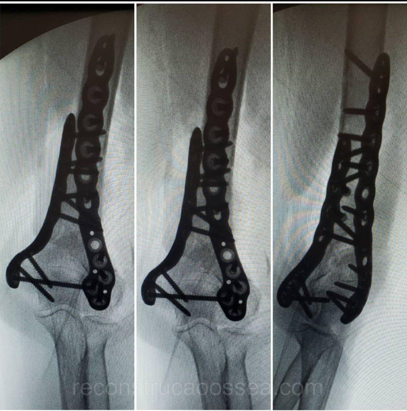 fratura-do-umero-distal-tratamento-cirurgico-6