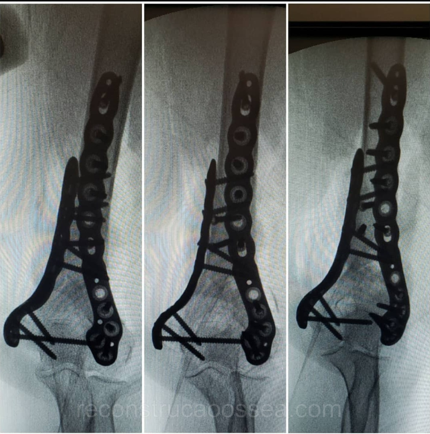 fratura-do-umero-distal-tratamento-cirurgico-8