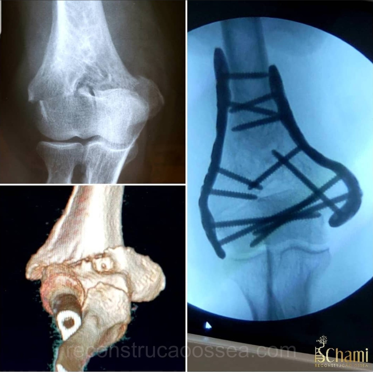 fratura-do-umero-distal-tratamento-cirurgico-9