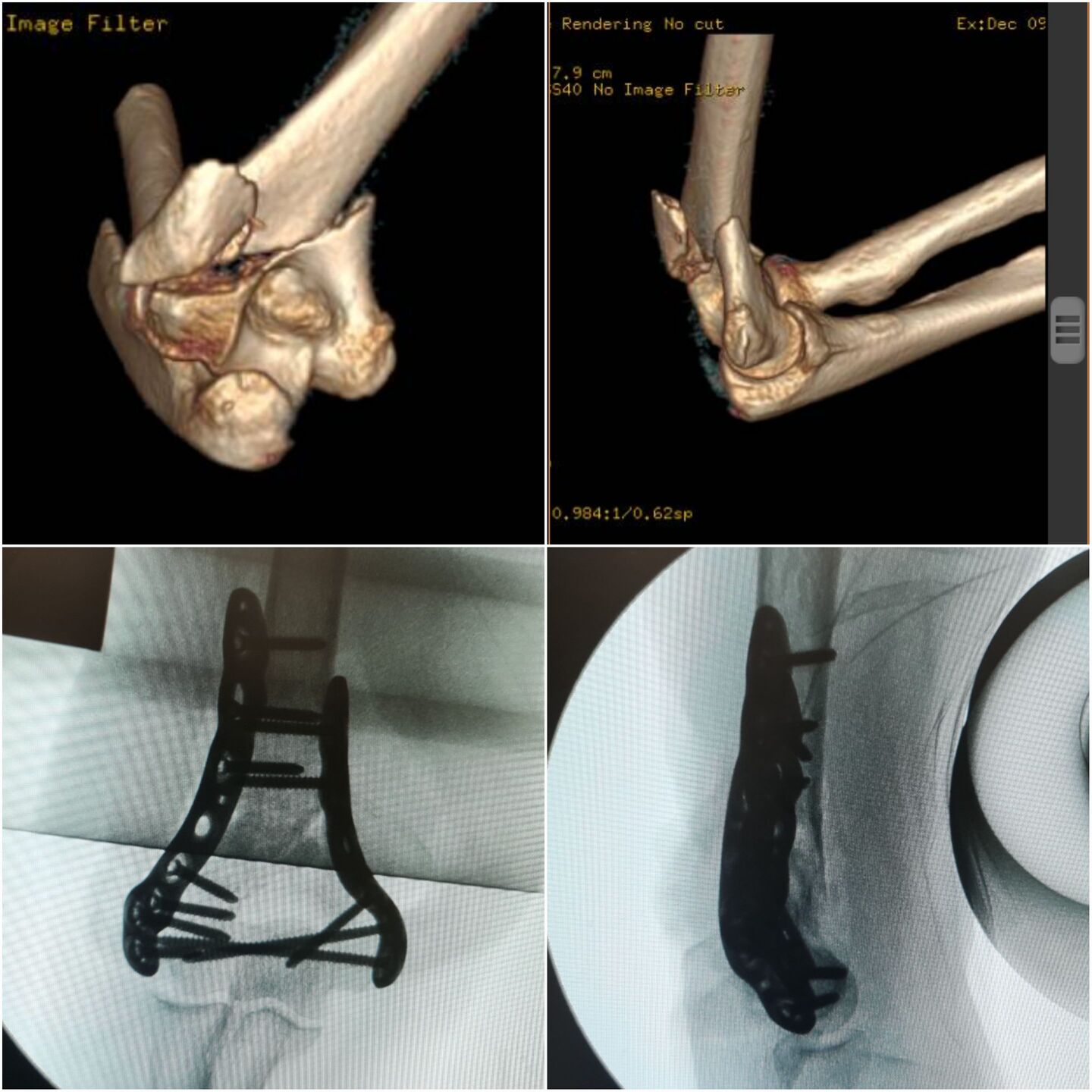 fratura-do-umero-distal