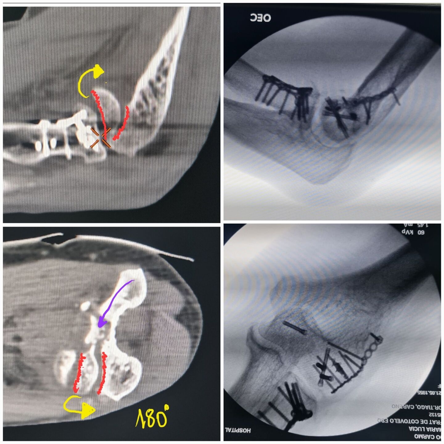 fratura-do-umero-distal111