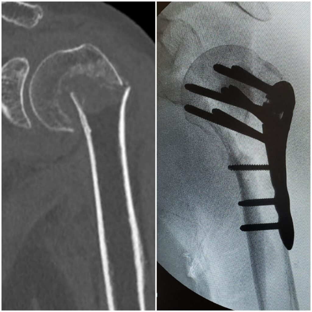 fratura-do-umero-proximal