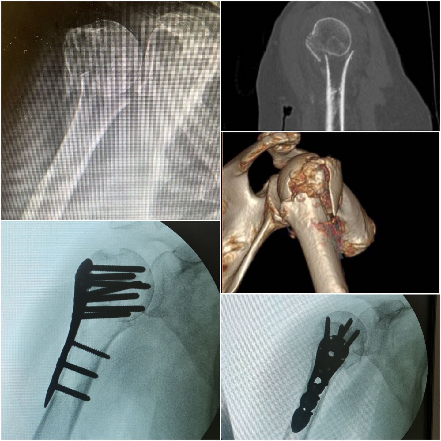 fratura-do-umero-proximal-13