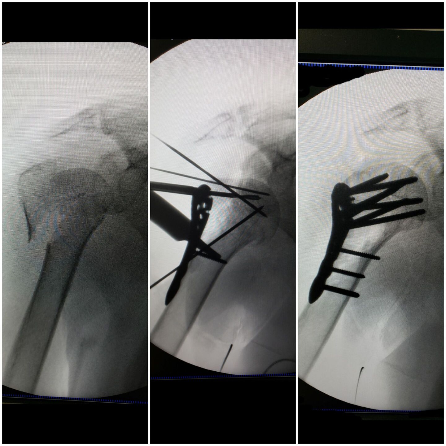 fratura-do-umero-proximal-26