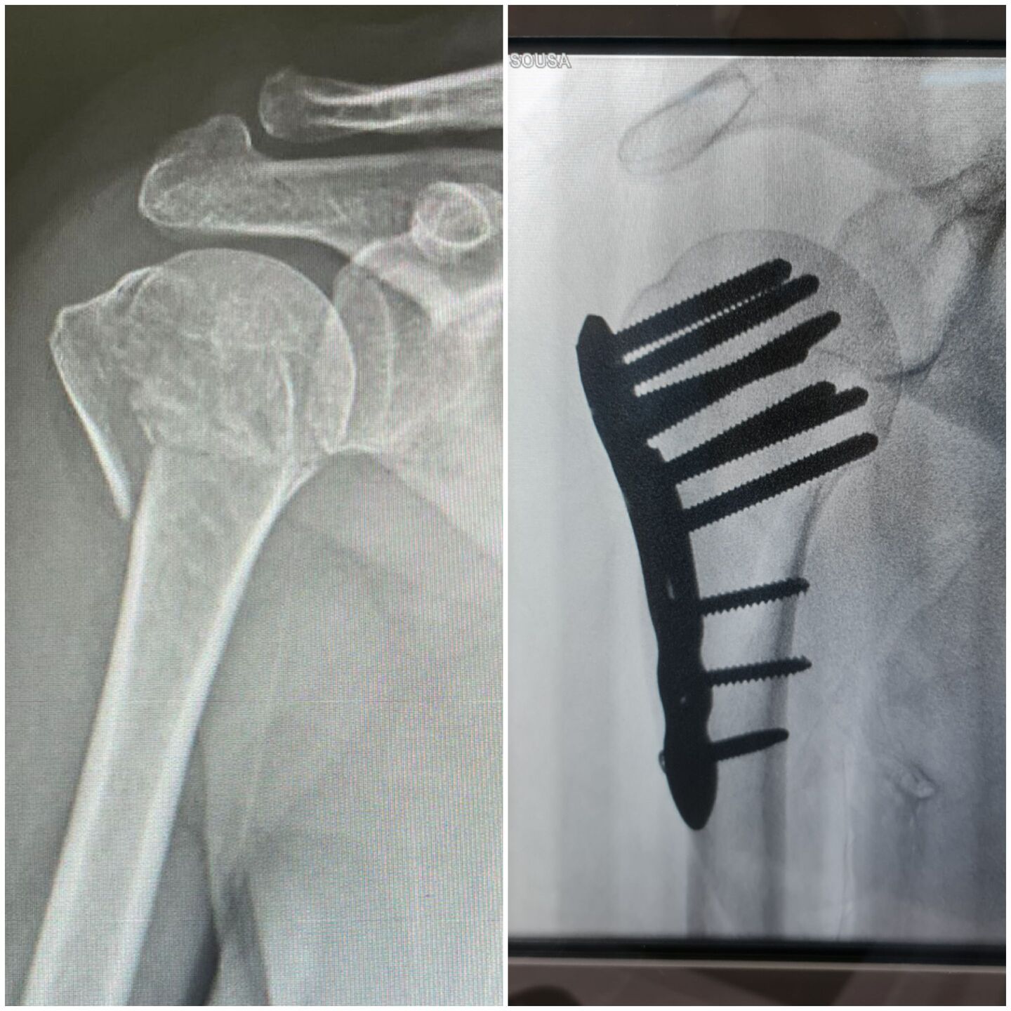 fratura-do-umero-proximal-28