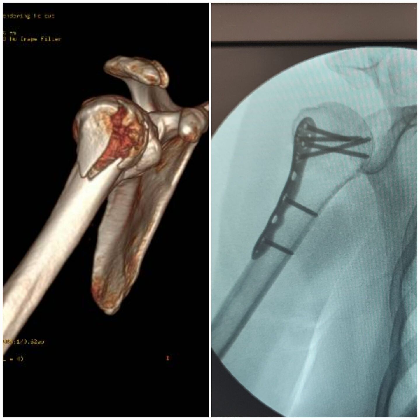 fratura-do-umero-proximal-3