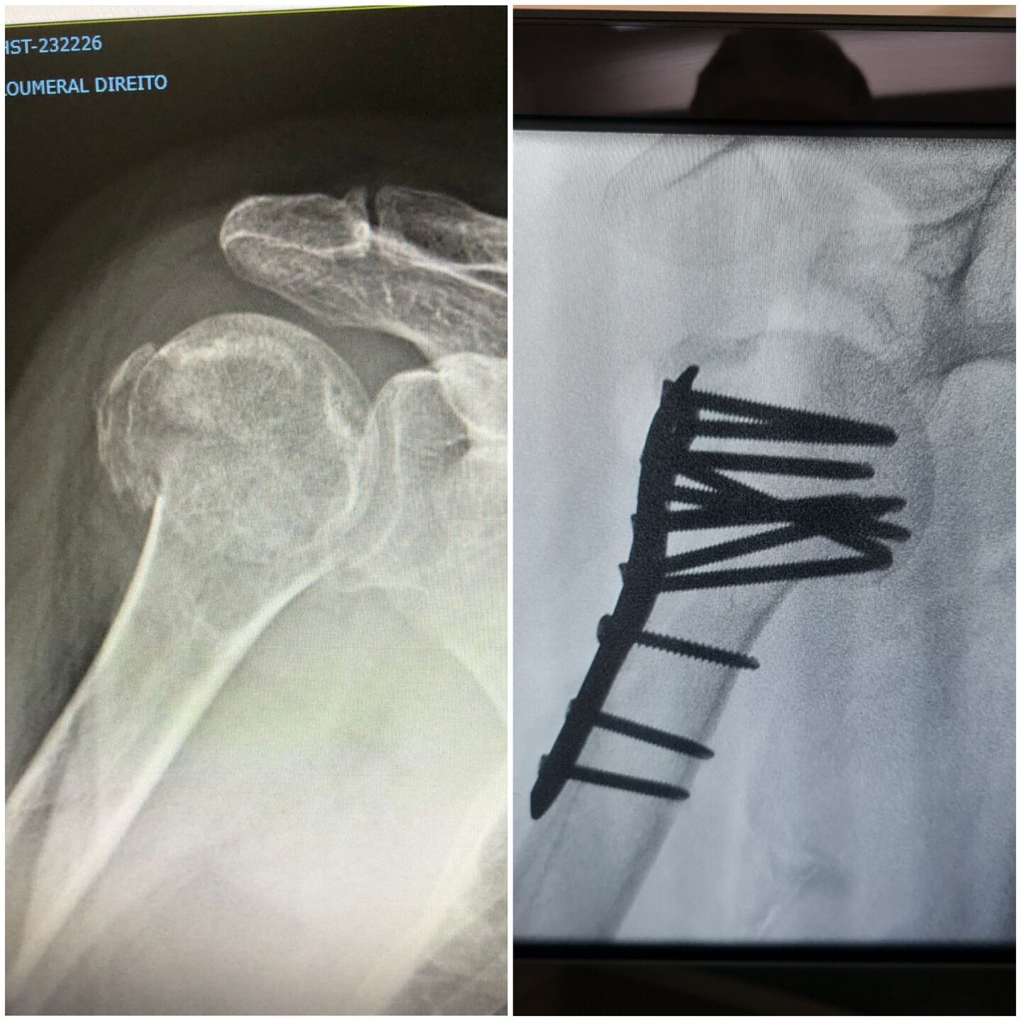 fratura-do-umero-proximal-31