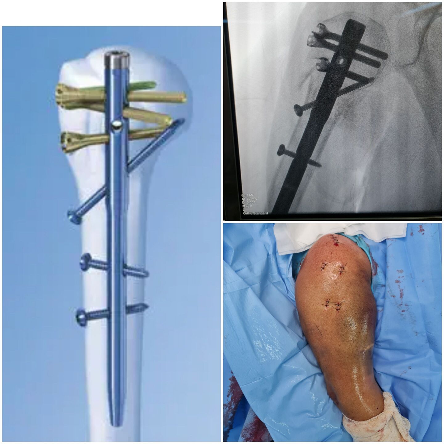 fratura-do-umero-proximal-33