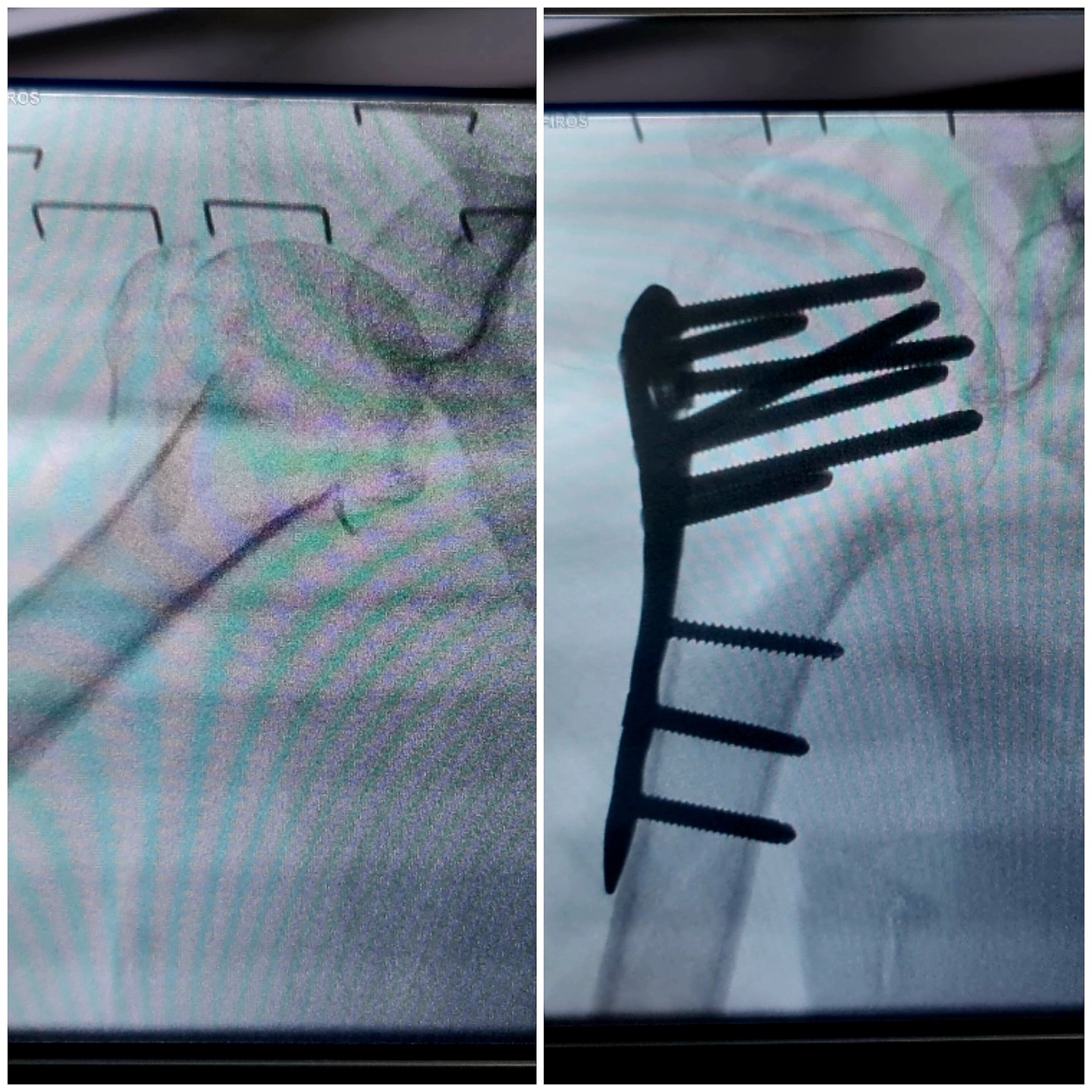 fratura-do-umero-proximal-7