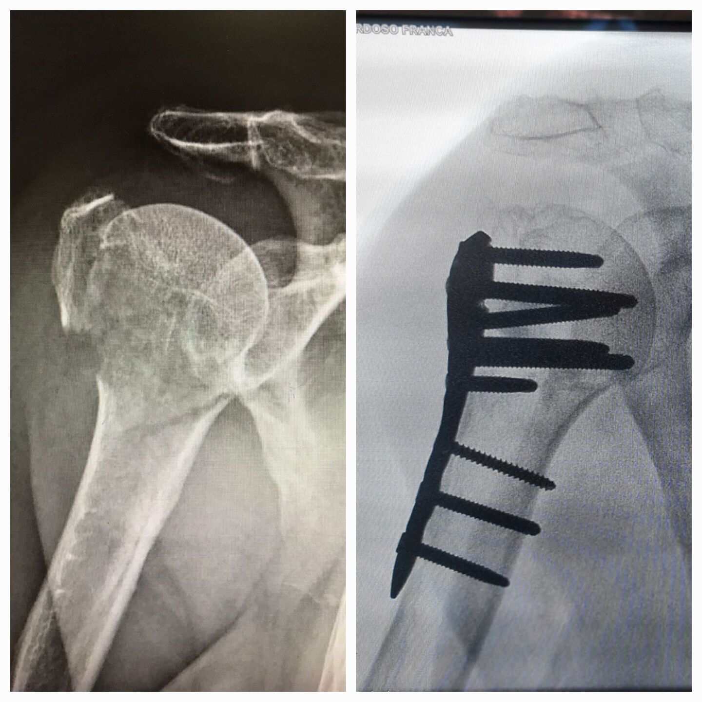 fratura-do-umero-proximal-8