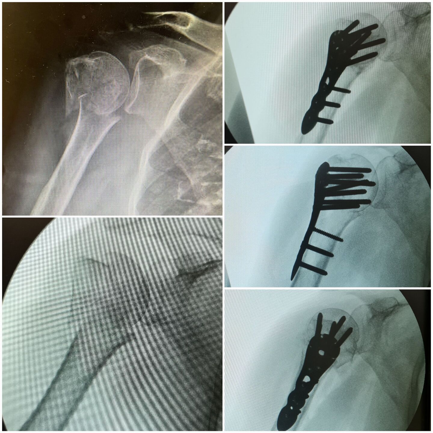 fratura-do-umero-proximal-9