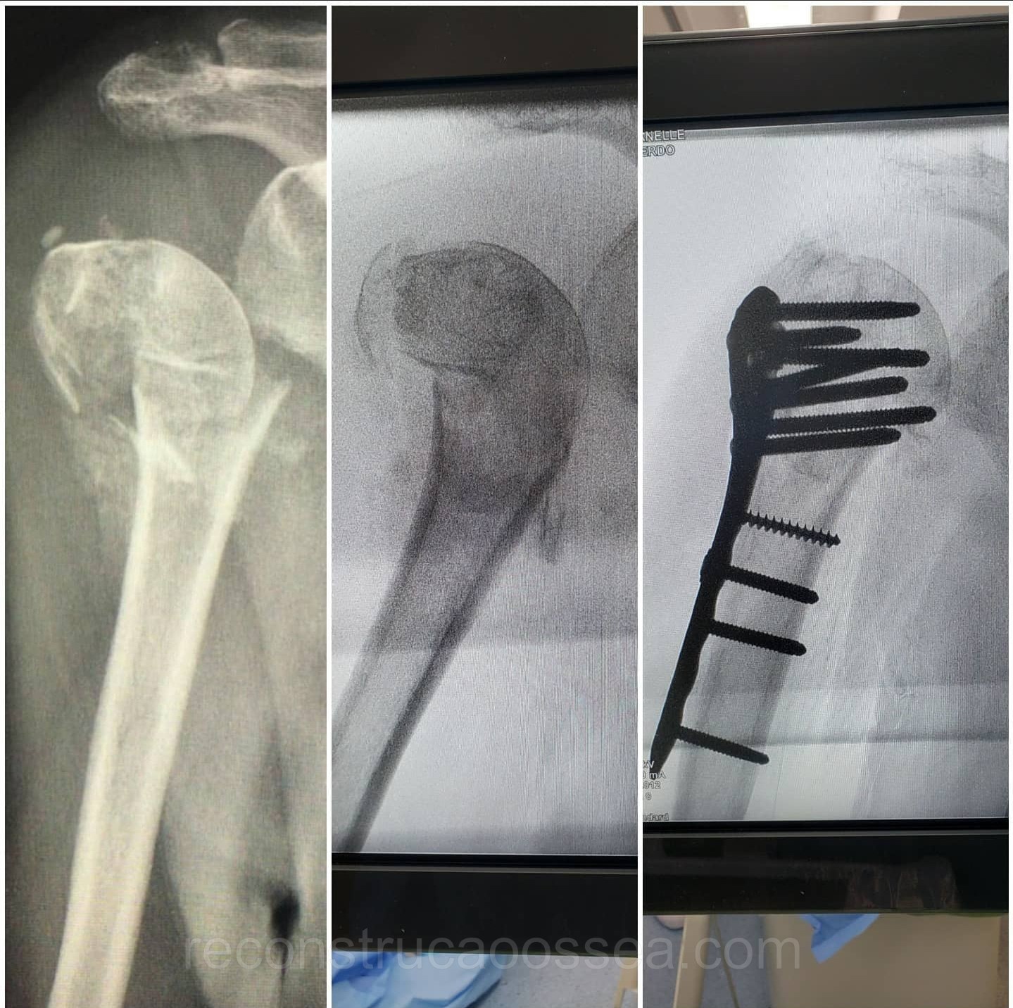fratura-do-umero-proximal-tratamento-cirurgico-14