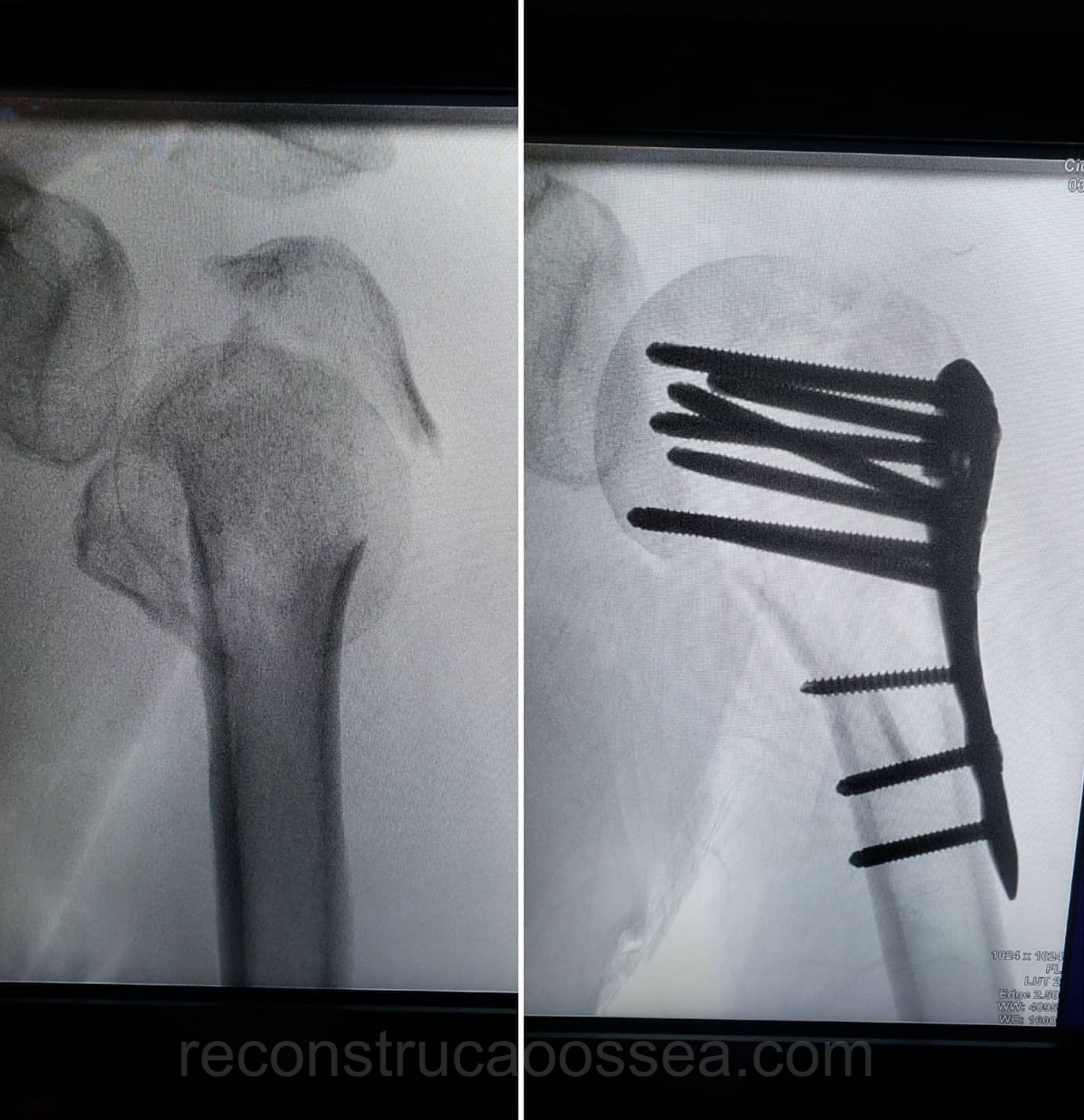 fratura-do-umero-proximal-tratamento-cirurgico-19