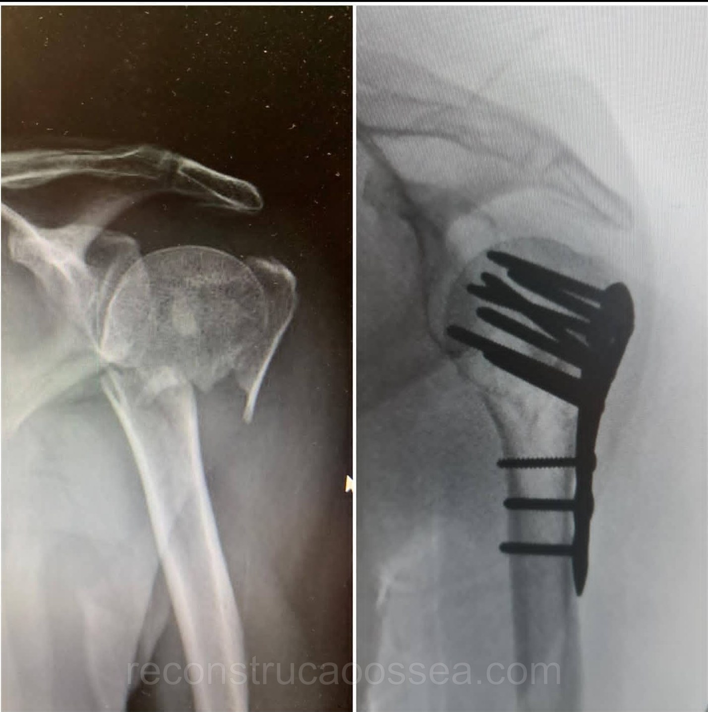 fratura-do-umero-proximal-tratamento-cirurgico-22