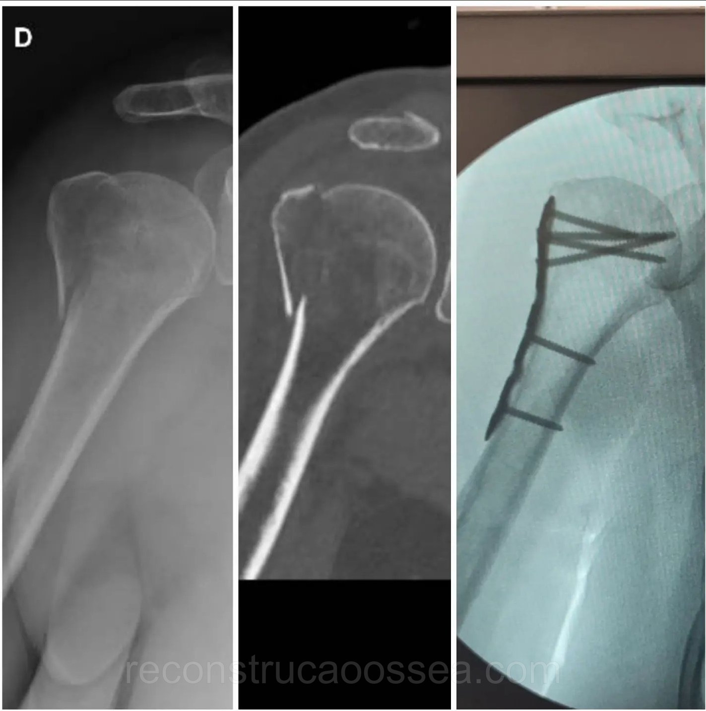 fratura-do-umero-proximal-tratamento-cirurgico-35