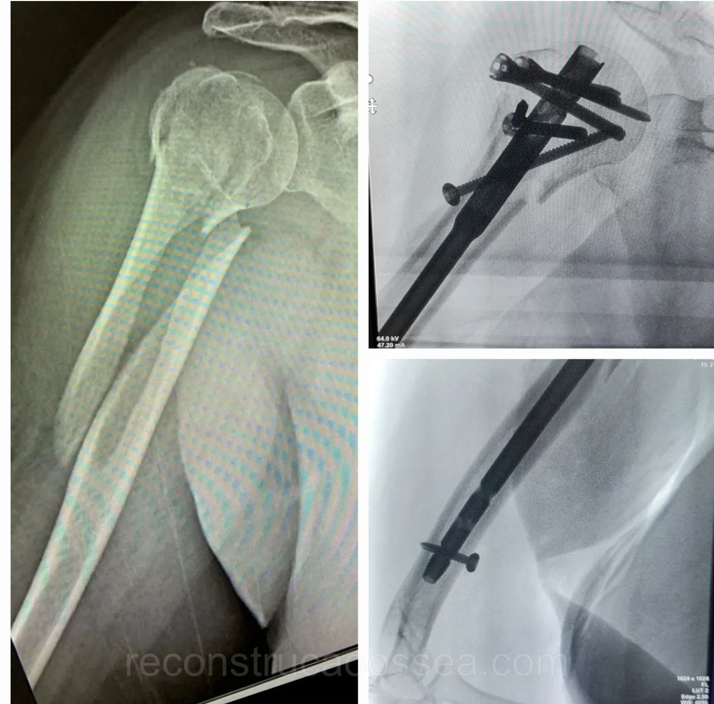 fratura-do-umero-proximal-tratamento-cirurgico-41