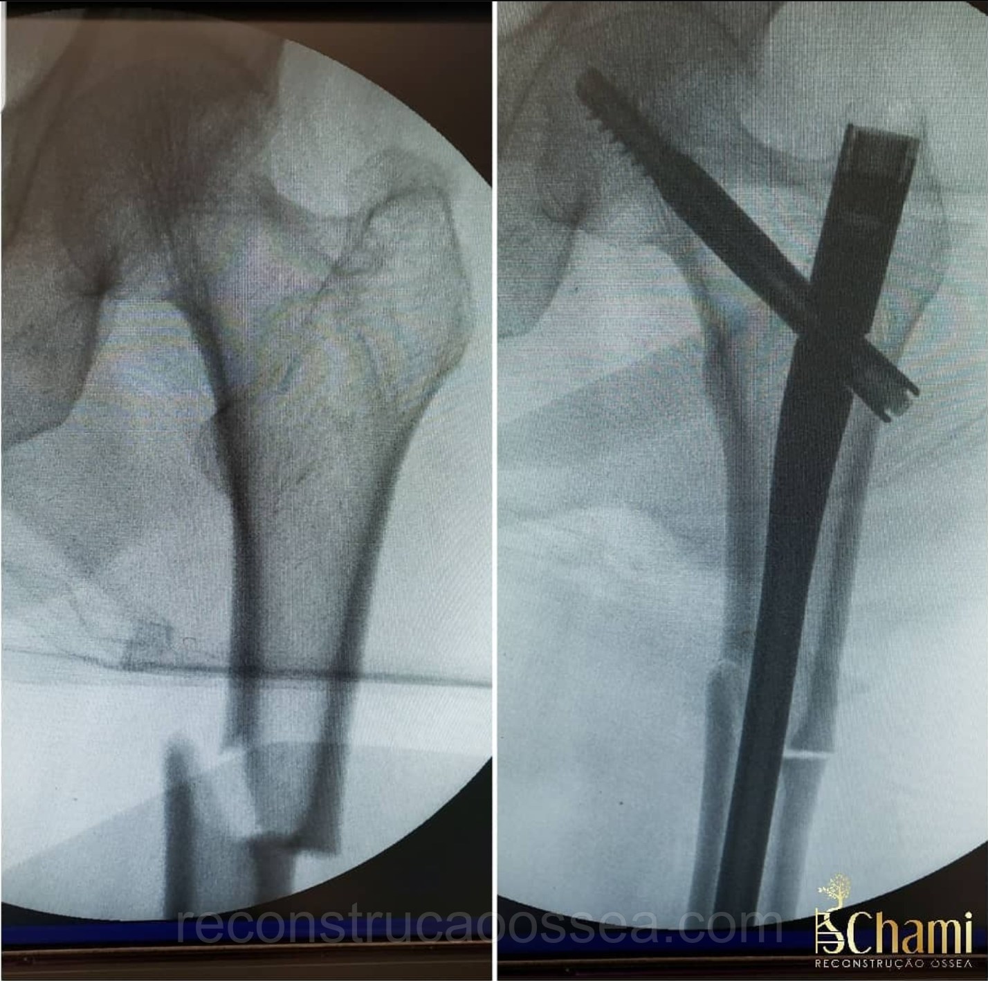 fratura-subtrocanteriana-tratamento-cirurgico-2