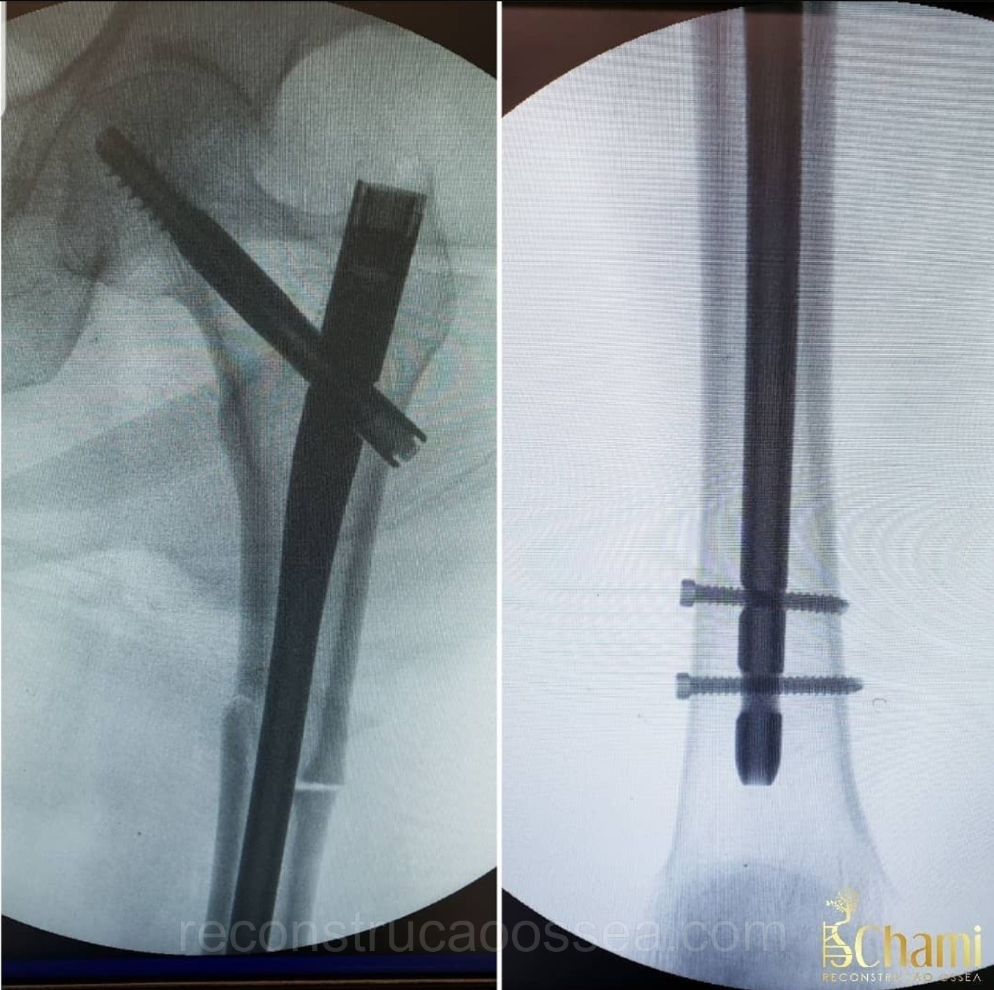 fratura-subtrocanteriana-tratamento-cirurgico-3