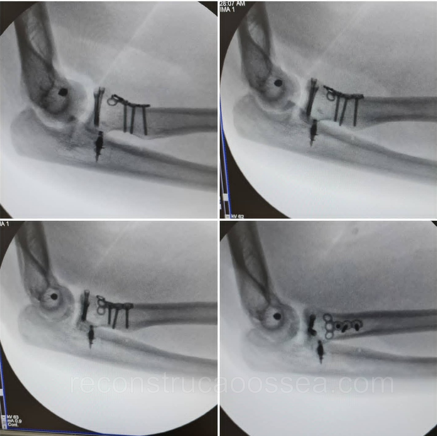 fraturas-complexas-do-cotovelo-triade-terrivel-do-cotovelo-21