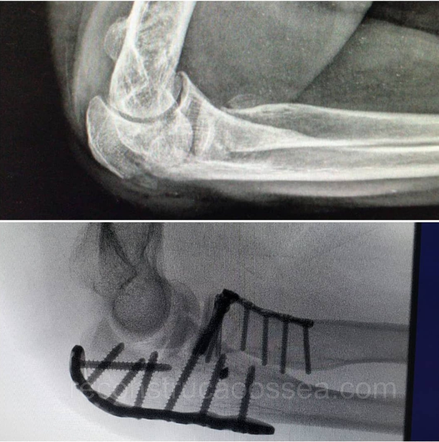 fraturas-complexas-do-cotovelo-triade-terrivel-do-cotovelo-9