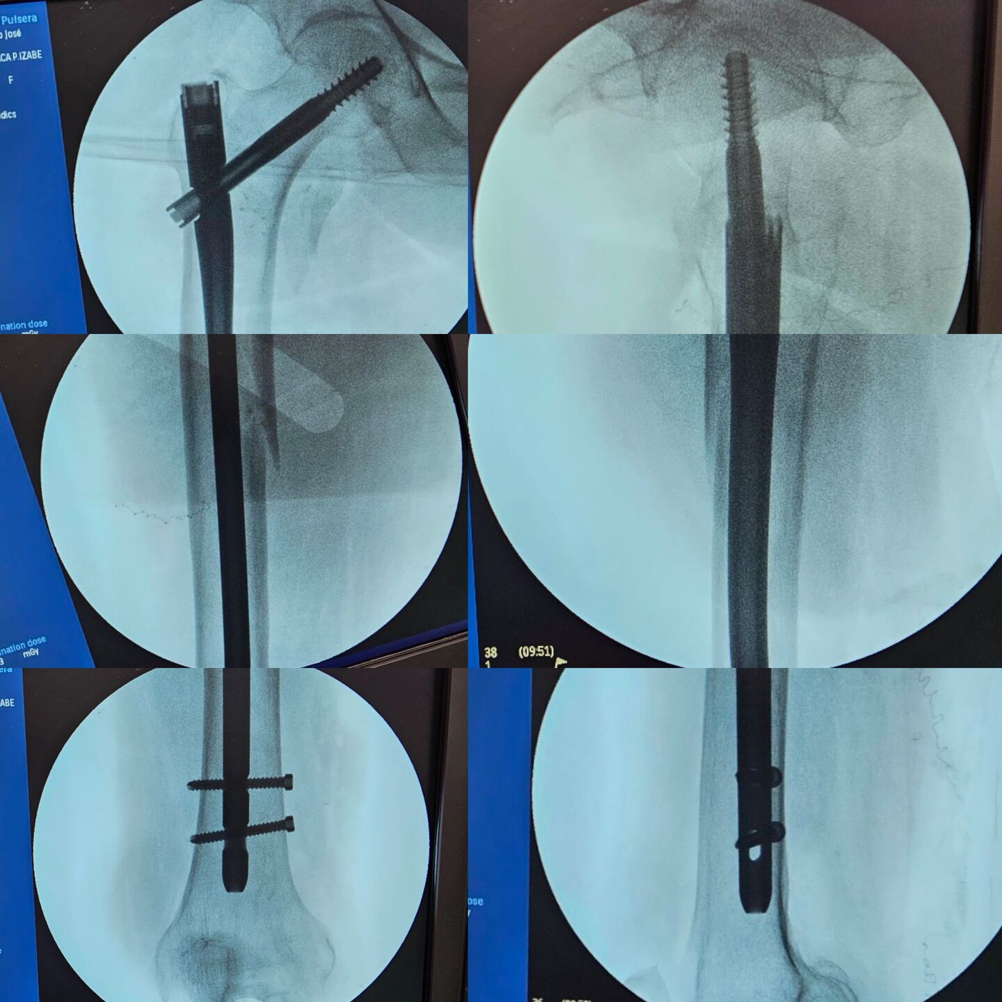 fraturas-subtrocanterianas-4